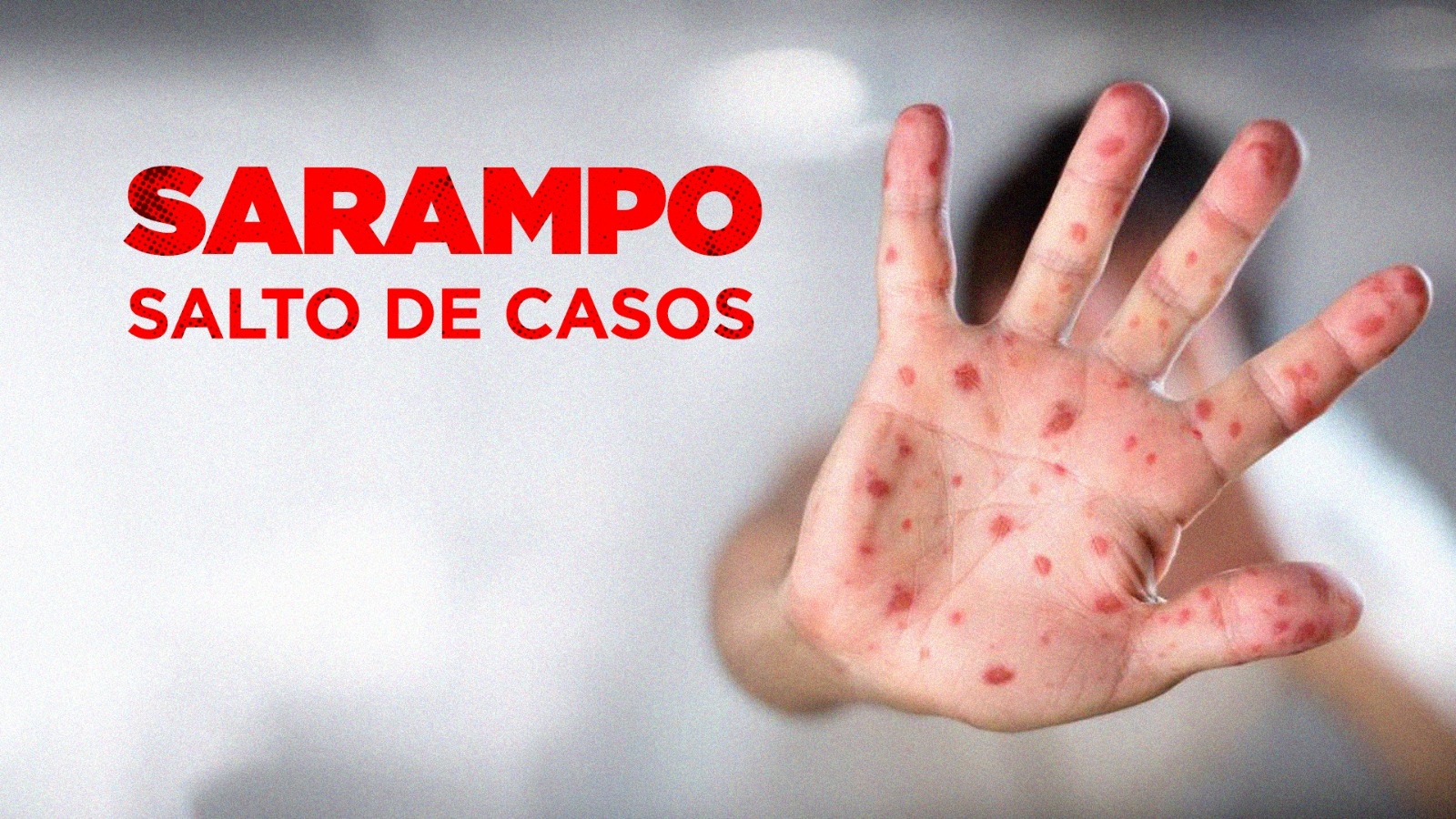 Saúde em risco: como o discurso antivacina pode reabrir as portas para o sarampo no Brasil
